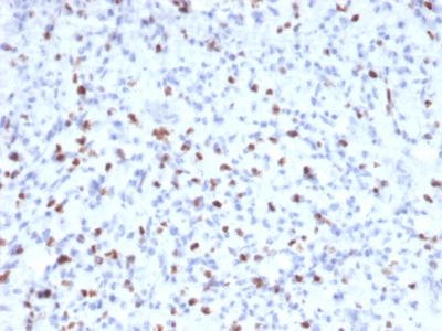 FFPE human rhabdomyosarcoma sections stained with 100 ul anti-Myogenin (clone MYOG/2660) at 1:100. HIER epitope retrieval prior to staining was performed in 10mM Citrate, pH 6.0.
